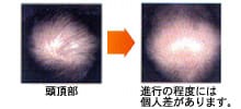 頭頂部 進行の程度には個人差があります。